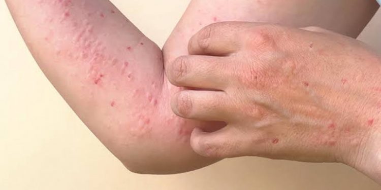 Dinkes Sebut Penerapan Prokes Bisa Cegah Penularan Cacar Monyet